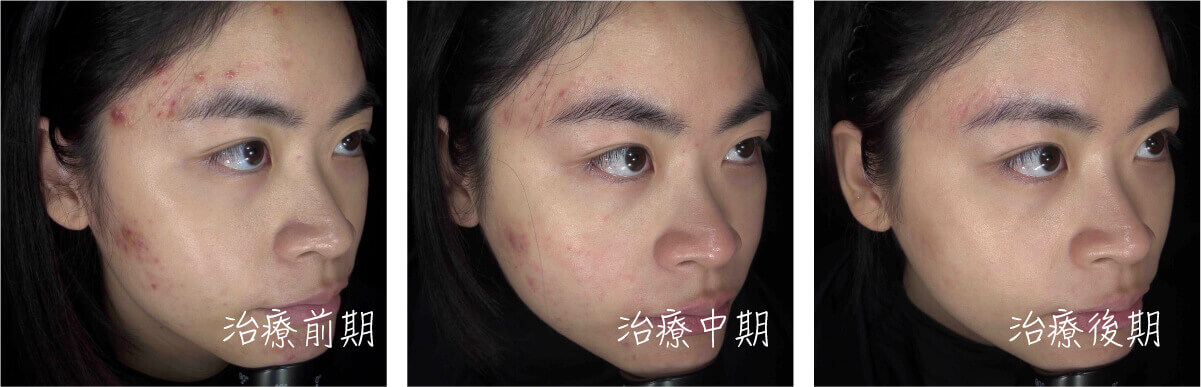染料雷射案例
