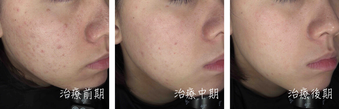 染料雷射案例