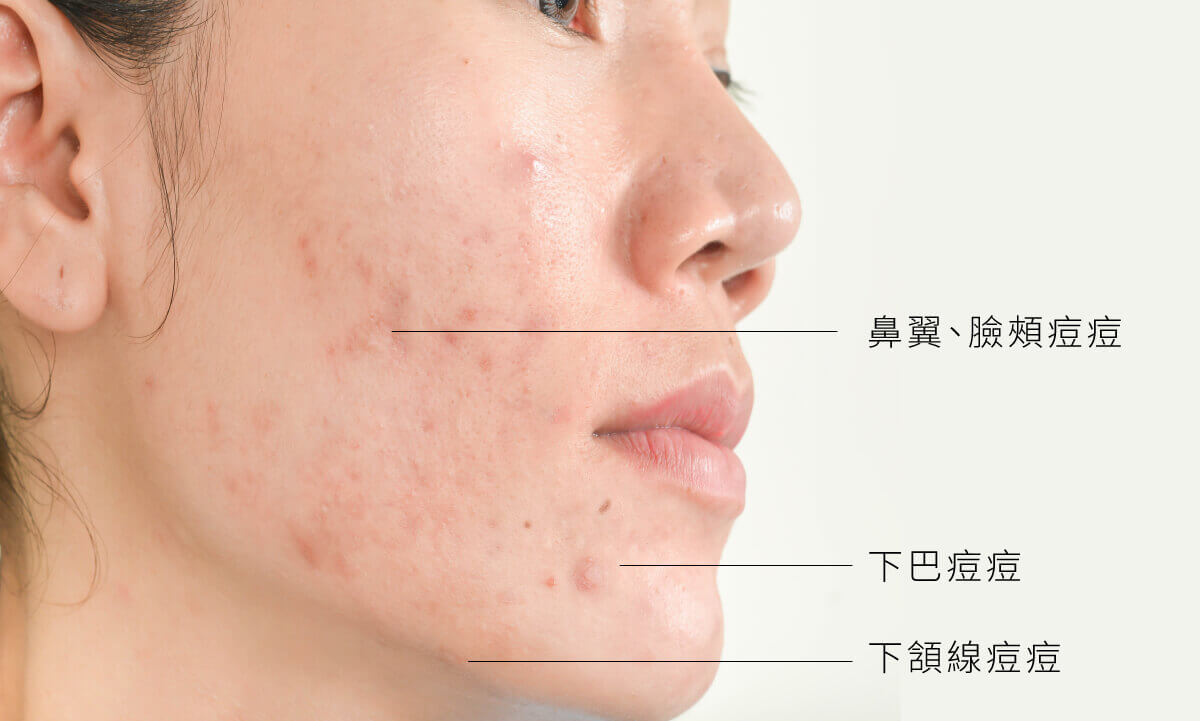 木木日安_痘痘位置