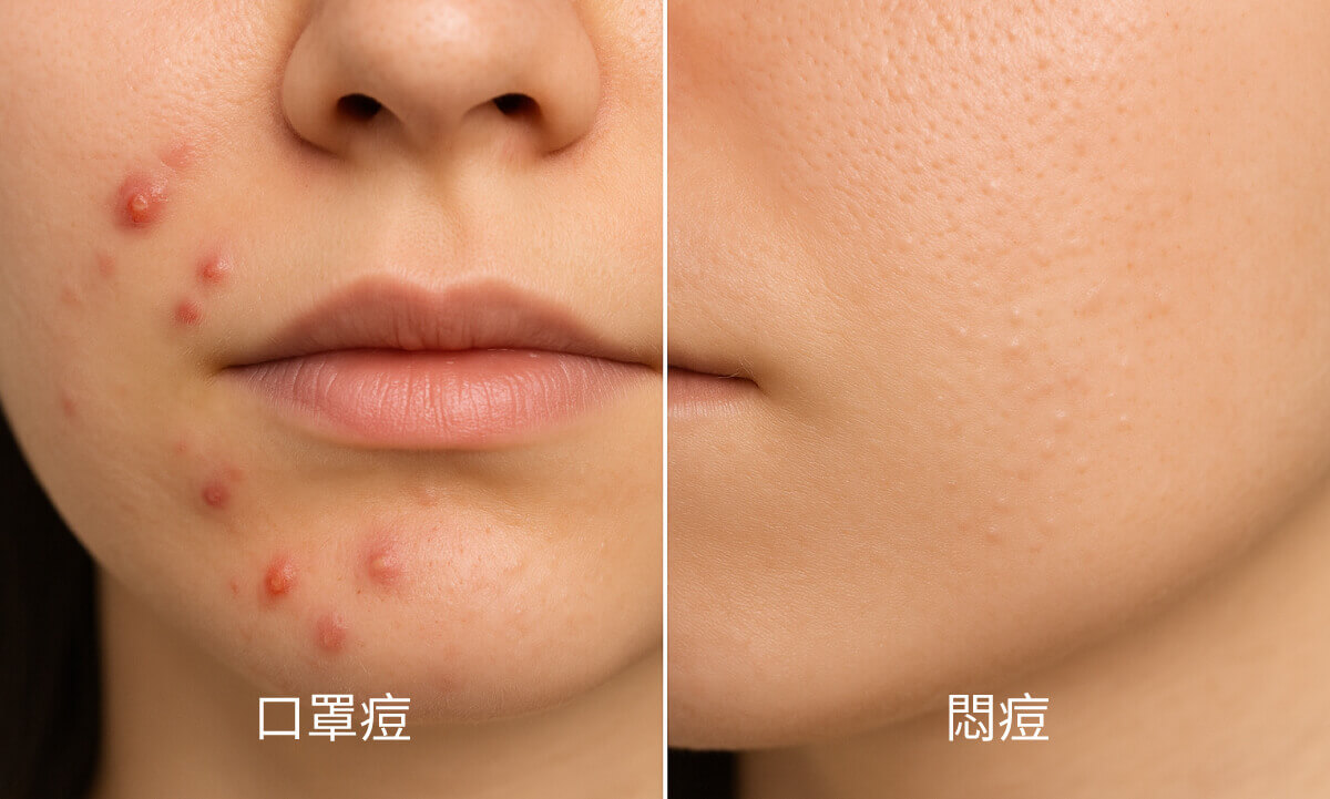 木木日安_痘痘類型比較